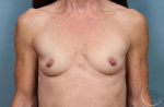 Breast Augmentation Case 9 Before